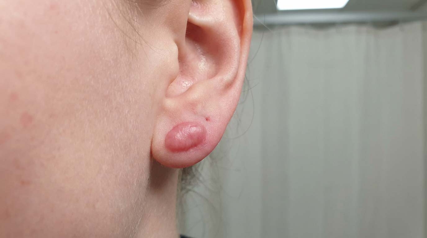 Earlobe with keloid scar — firm raised growth extending beyond the original piercing hole